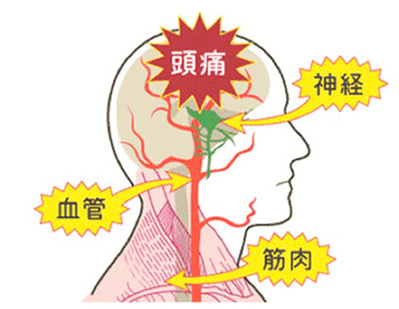 頭痛イメージ